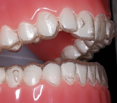 Mulher branca colocando os alinhadores dentais com as mãos